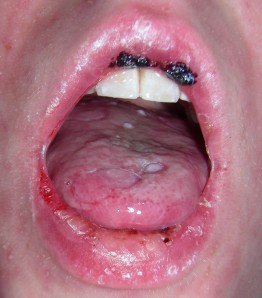 Pauley, A Mouth Blisters